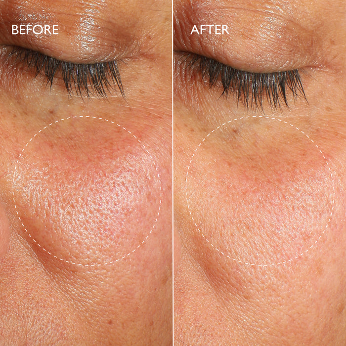 Renewal Ultime™ Multi-Acid Resurfacing Pads Travel Size