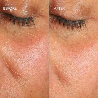 Renewal Ultime™ Multi-Acid Resurfacing Pads Travel Size