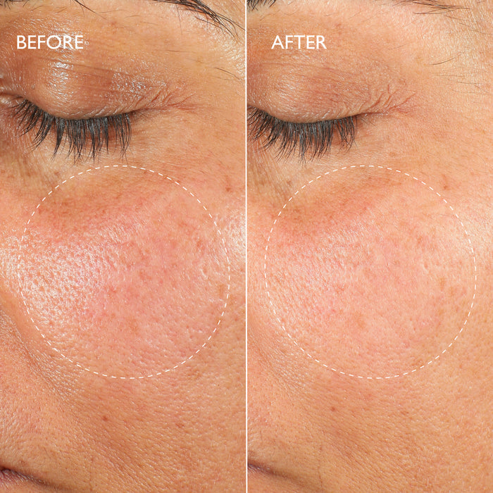Renewal Ultime™ Multi-Acid Resurfacing Pads Travel Size