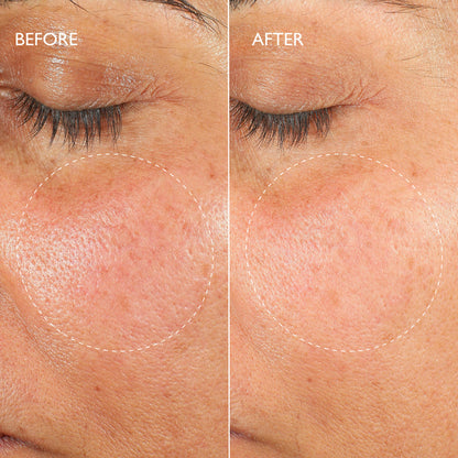 Renewal Ultime™ Multi-Acid Resurfacing Pads Travel Size