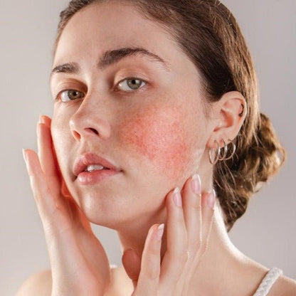 Rosacea - MD Aesthetics
