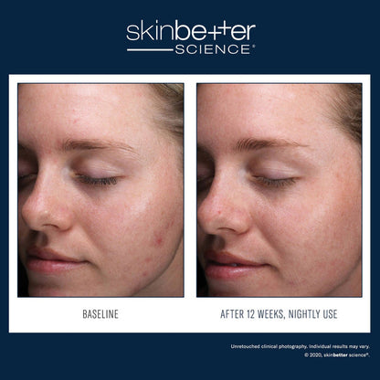 SkinBetter AlphaRet Clearing Serum 30ml